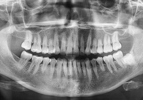 Hyperdontia x-ray on human mouth.