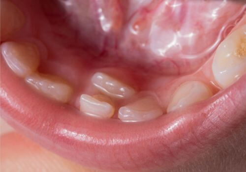 Hyperdontia on human mouth.